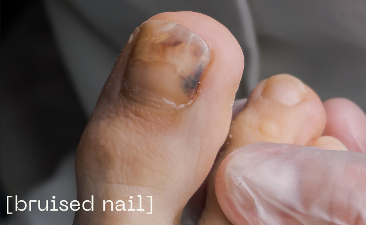 Smashed Fingernail Blood Draining: DIY Surgery - YouTube