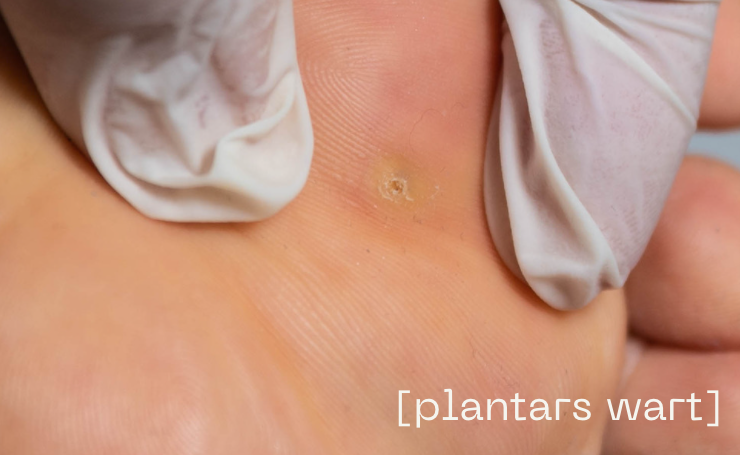 Plantar Warts Dérmica MedEsthetics