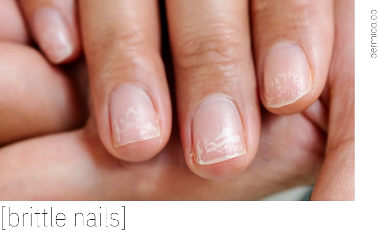 What do your nails tell you about your nutrition? | drshrutisharma