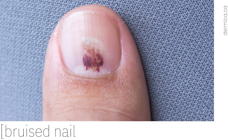 Injury To The Nail Due To Wearing Uncomfortable Shoestreatment Of Hematoma  Of Toenailmedicine Conceptshoe Nail Injury Stock Photo - Download Image Now  - iStock