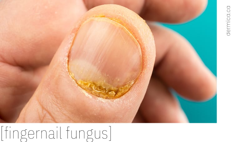 Amazon.com: Toenail Fungus Treatment-Extra Strength Nail Fungus Solution  for Toenail & Fingernail, Repair Liquid for Thick Cracked Discolored Nails,  Restore Nail Health