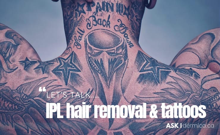 IPL and Laser Hair Removal and Tattoos