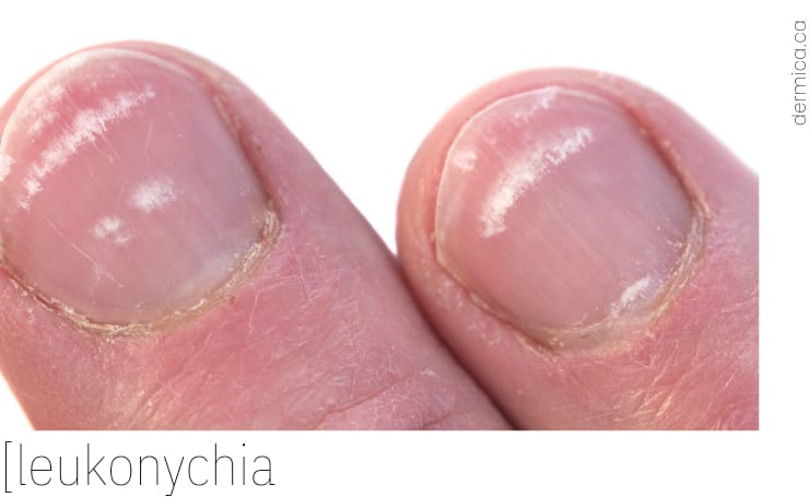 What causes white spots on nails? - Dérmica MedEsthetics