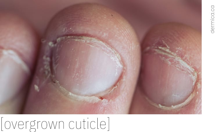 Why are my cuticles peeling? - Dérmica MedEsthetics