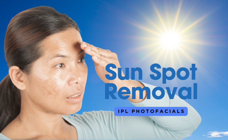 Sun Spot Removal Yeg Dérmica Medesthetics 0386